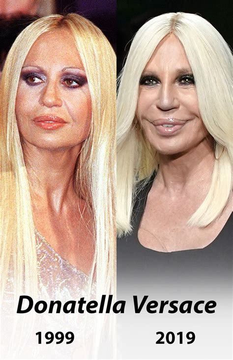 donatella versace vorher nachher|Donatella Versace.